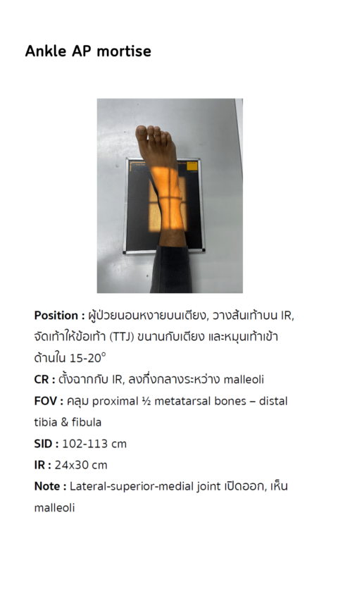 Ankle AP mortise | VJR RTtech